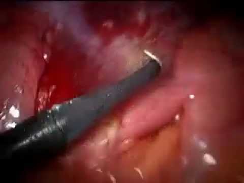 Appendix Operation Video