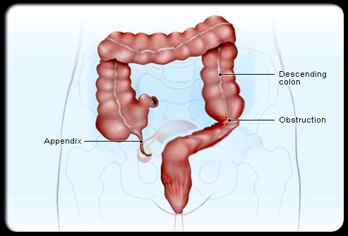 Appendix Operation Video