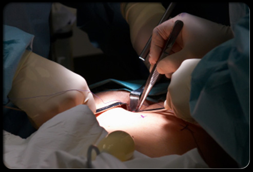 Appendix Operation Video