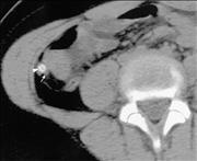 Appendix Pain Location In Children