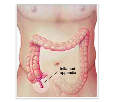 Appendix Pain Location In Women