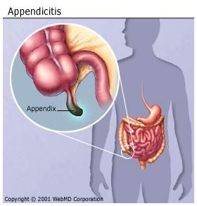 Appendix Pain Symptoms Gas