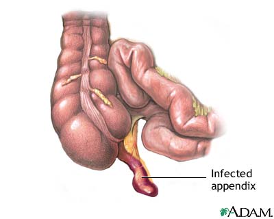 Appendix Pain Symptoms How Long