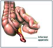 Appendix Removal Cost