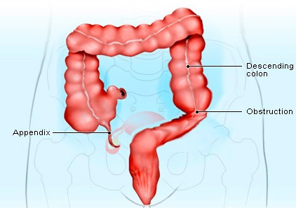 Appendix Removal Cost