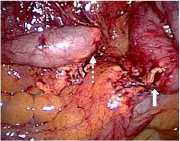 Appendix Removal Recovery Time Laparoscopic