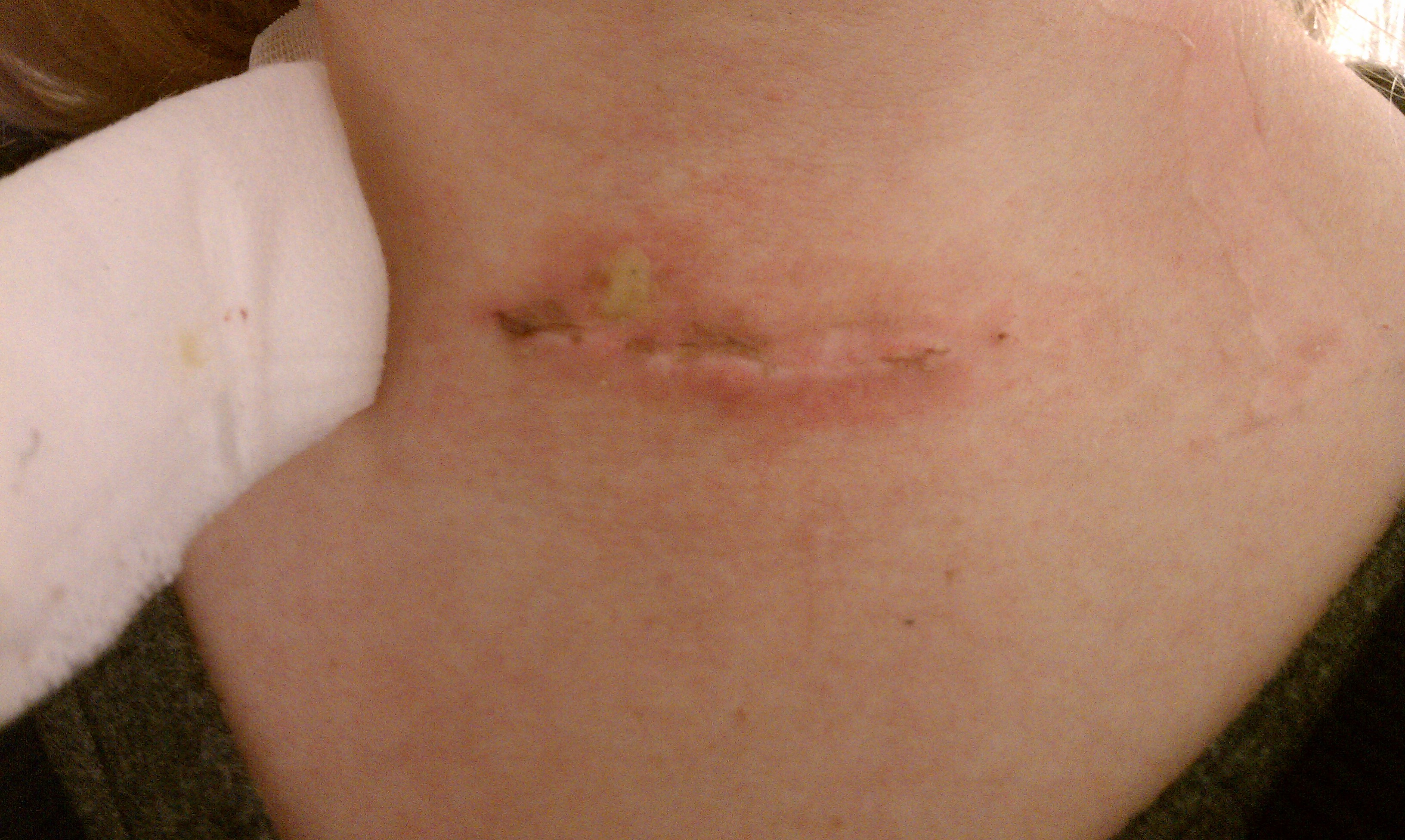 Appendix Removal Scar