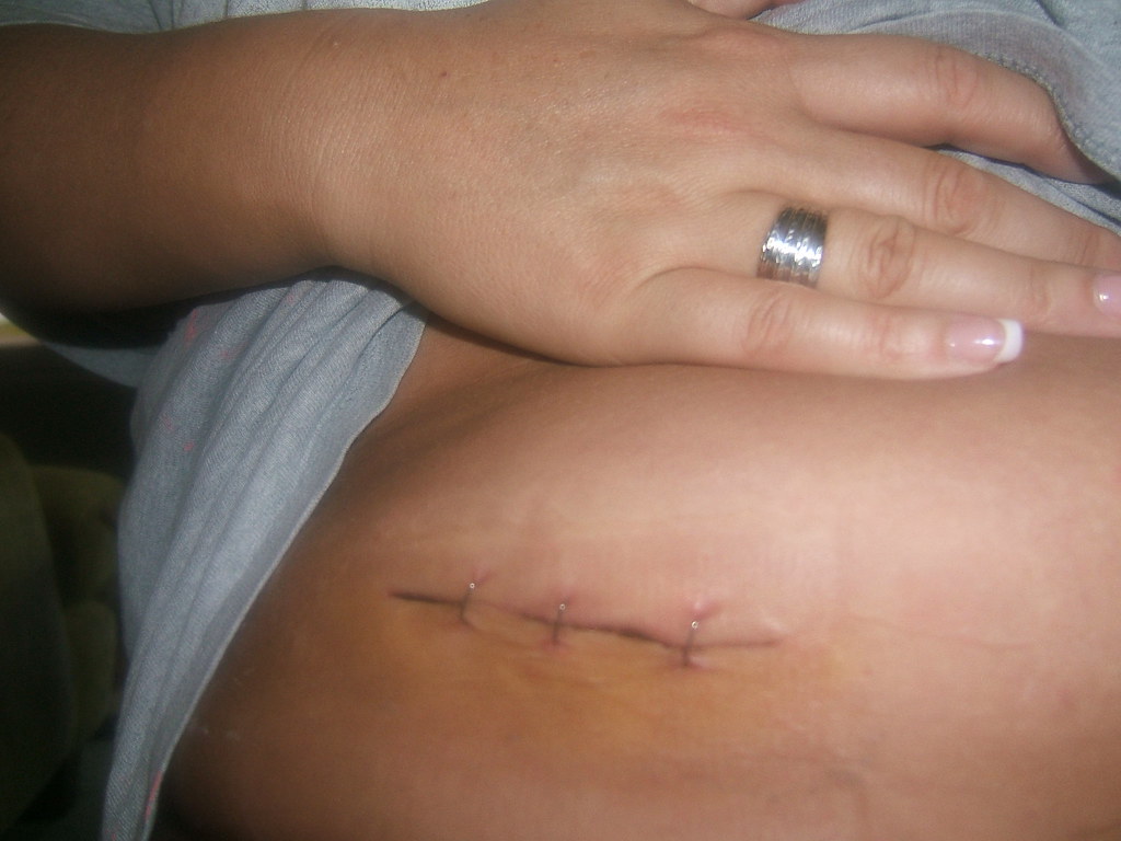 Appendix Removal Scar