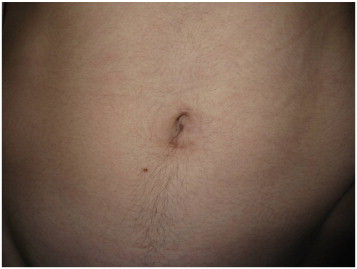 Appendix Removal Scar