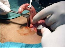 Appendix Removal Surgery Cost