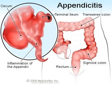 Appendix Removal Symptoms