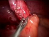 Appendix Removal Video