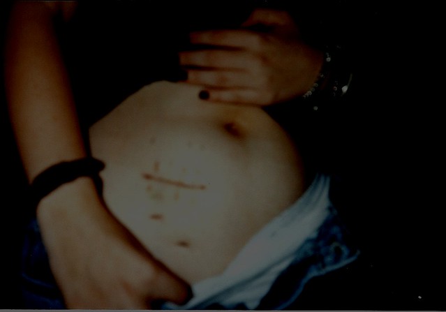 Appendix Scar