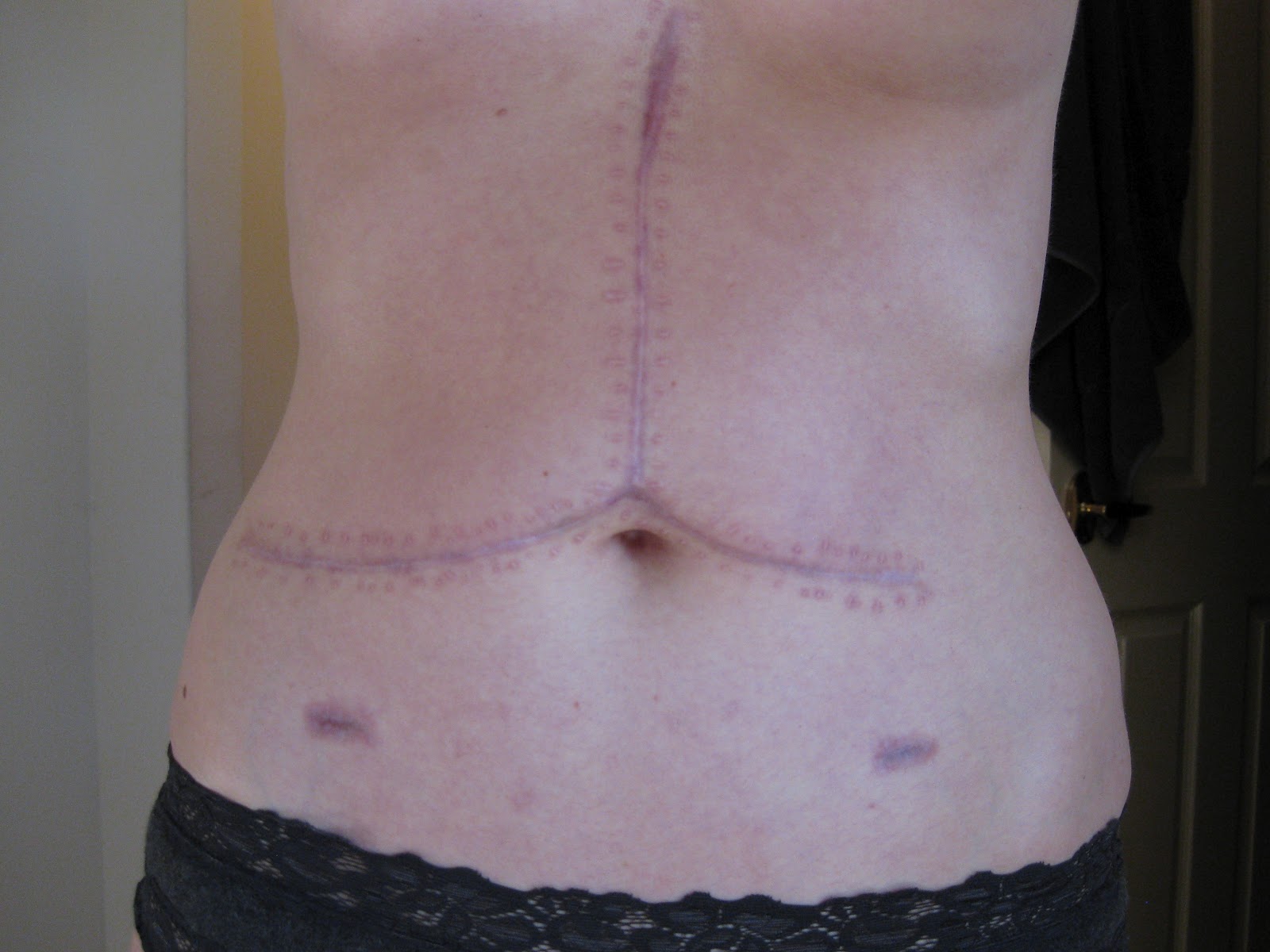 Appendix Scar