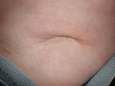 Appendix Scar On Left Side