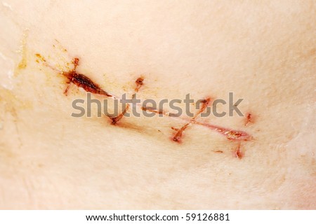 Appendix Scar Pain