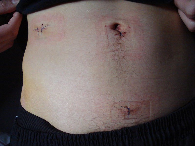 Appendix Scar Pain