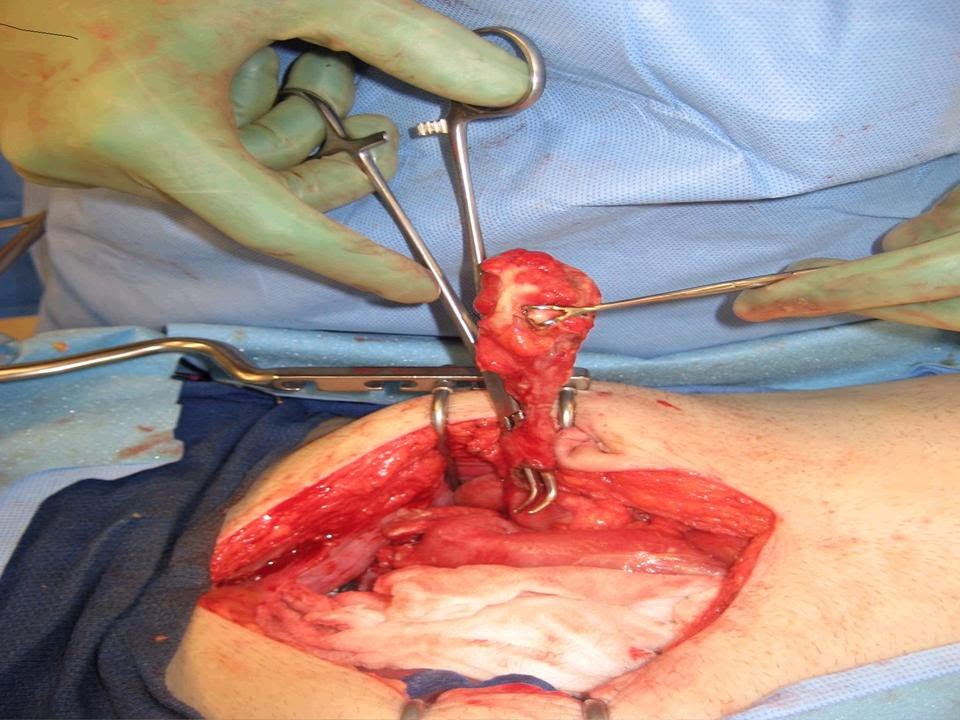 Appendix Scar Pain