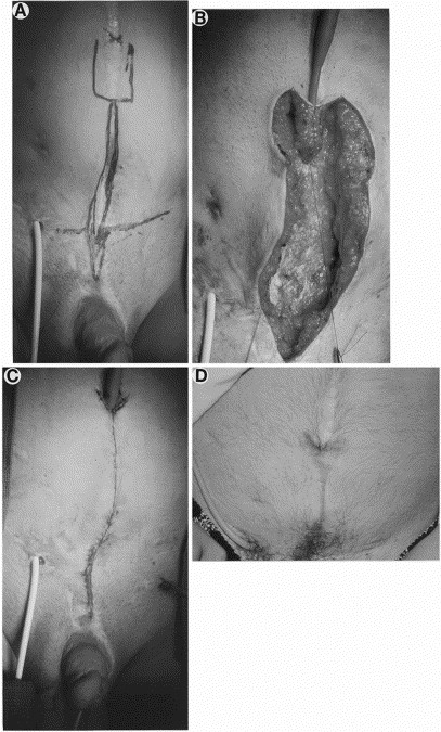 Appendix Scar Revision