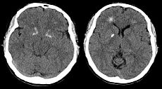 Autosomal Dominant Disorders Mnemonic