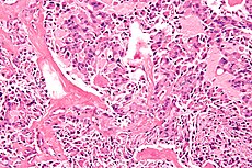 Autosomal Dominant Disorders Mnemonic