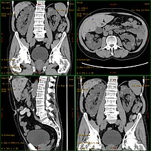 Autosomal Dominant Polycystic Kidney Disease Aneurysm