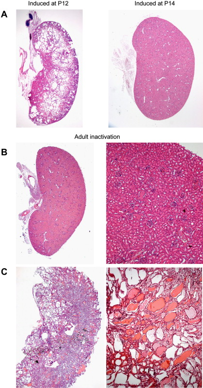 Autosomal Dominant Polycystic Kidney Disease Aneurysm