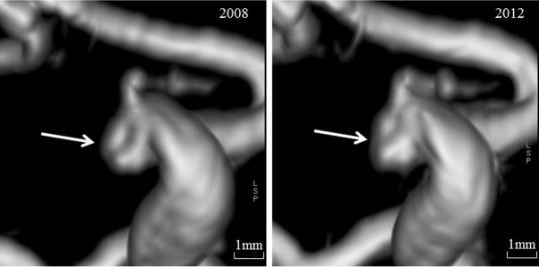 Autosomal Dominant Polycystic Kidney Disease Aneurysm