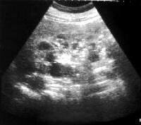 Autosomal Dominant Polycystic Kidney Disease Genetics