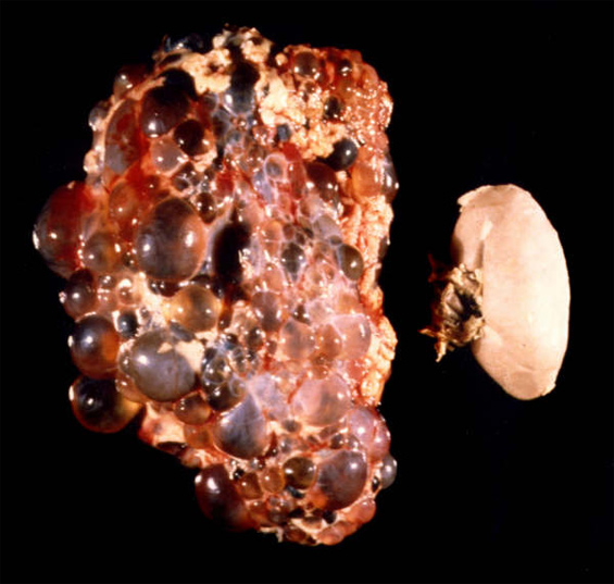 Autosomal Dominant Polycystic Kidney Disease Genetics