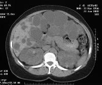 Autosomal Dominant Polycystic Kidney Disease Genetics