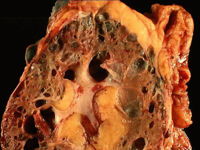 Autosomal Dominant Polycystic Kidney Disease Genetics