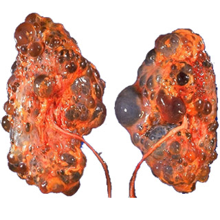 Autosomal Dominant Polycystic Kidney Disease Symptoms