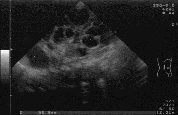 Autosomal Dominant Polycystic Kidney Disease Ultrasound