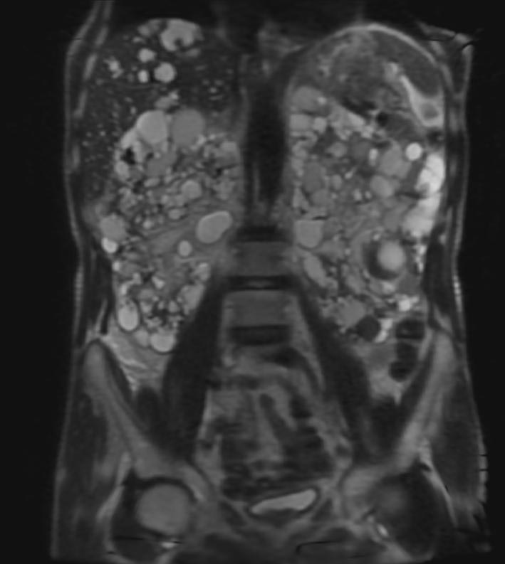 Autosomal Dominant Polycystic Kidney Disease Ultrasound