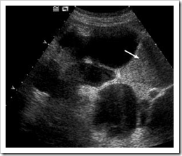 Autosomal Dominant Polycystic Kidney Disease Ultrasound