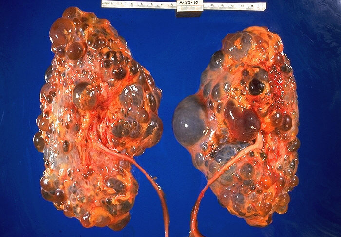 Autosomal Dominant Polycystic Kidney Disease Ultrasound