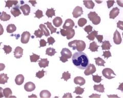 Autosomal Recessive Inheritance Lactose Metabolism Is Blocked