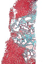 Autosomal Recessive Polycystic Kidney Disease (arpkd)