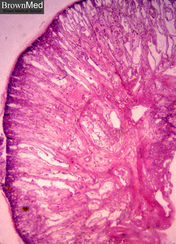 Autosomal Recessive Polycystic Kidney Disease (arpkd)