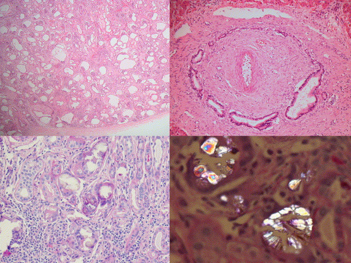 Autosomal Recessive Polycystic Kidney Disease Cysts Form From The