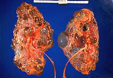 Autosomal Recessive Polycystic Kidney Disease Histology