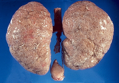 Autosomal Recessive Polycystic Kidney Disease Histology