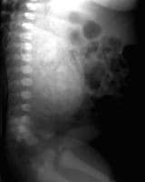 Autosomal Recessive Polycystic Kidney Disease In Fetus