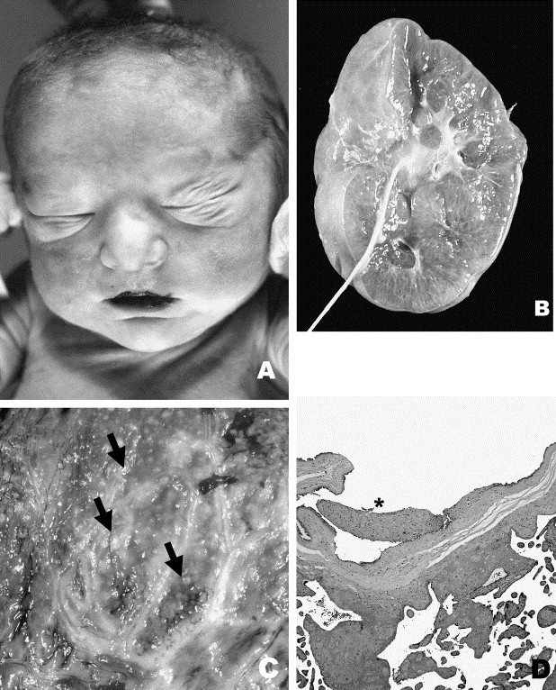 Autosomal Recessive Polycystic Kidney Disease In Fetus