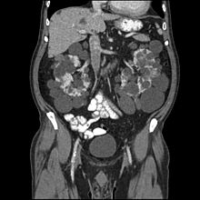 Autosomal Recessive Polycystic Kidney Disease In Fetus