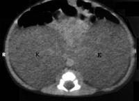 Autosomal Recessive Polycystic Kidney Disease Symptoms