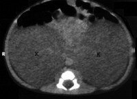 Autosomal Recessive Polycystic Kidney Disease Treatment