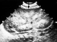 Autosomal Recessive Polycystic Kidney Disease Ultrasound