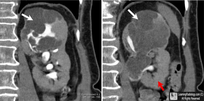 Autosomal Recessive Polycystic Kidney Disease Ultrasound